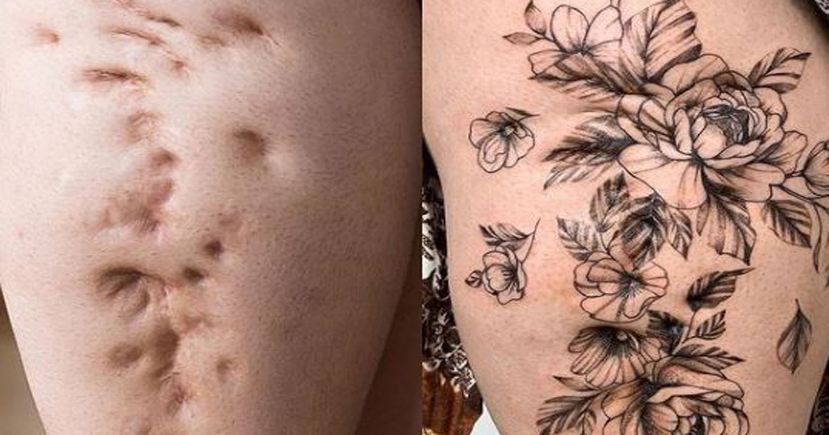 Tatuagem é usada para cobrir cicatrizes