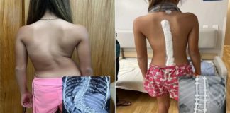 Após cirurgia, menina que tinha 'coluna em S' anda pela 1ª vez com postura correta: 'Aliviada e feliz', diz mãe