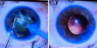 Em vídeo, médico oftalmologista mostra como é feita a cirurgia de catarata - assista!